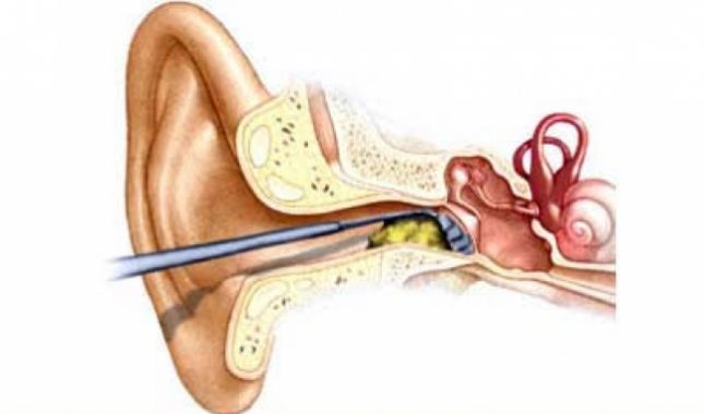 Vosak u ušima je puno korisniji nego što ste to ikada mogli i pomisliti
