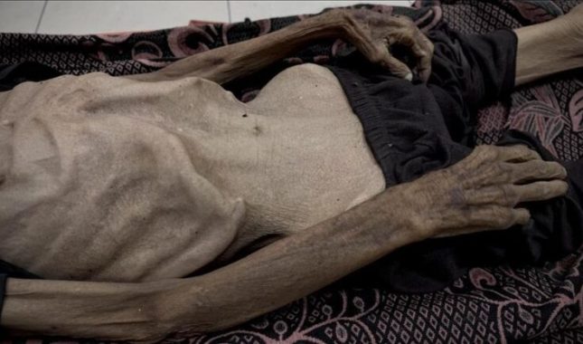U tri sedmice kod više od 1.000 osoba u Gazi dijagnosticirana pothranjenost, od gladi umrla 332 Palestinca, uključujući 124 djece